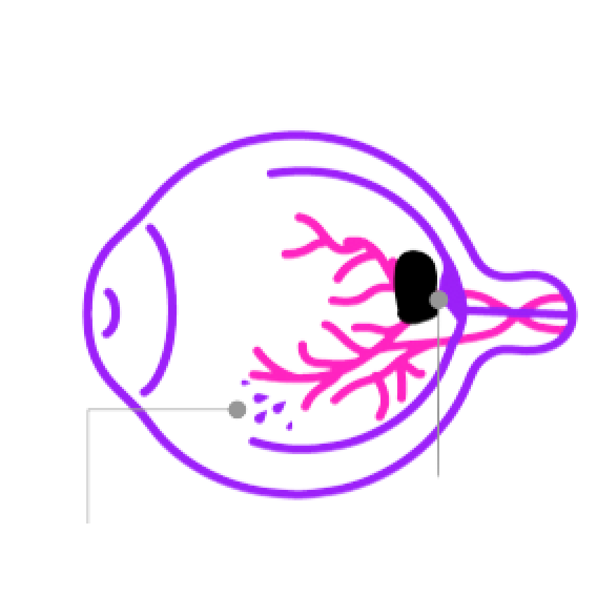 איור המדגים את הדליפה לרשתית שעלולה להוביל להצטברות נוזלים ולנפיחות ברשתית, הנקראת גם בצקת