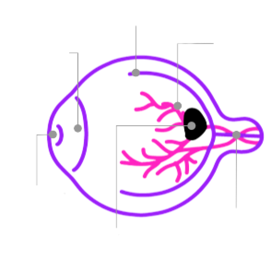 איור המדגים את כלי הדם שניזוקו ומתחילים לדלוף לתוך הרשתית