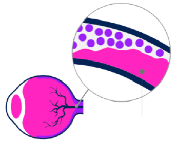 איור המדגים פלאק החוסם את וריד הרשתית
